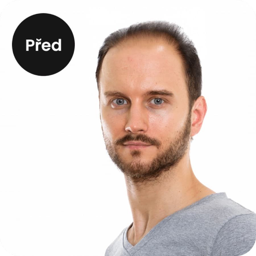 Před transplantací