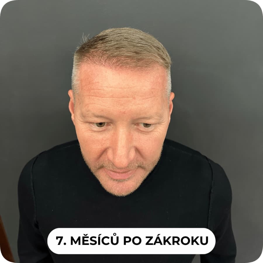 7 měsíců po zákroku