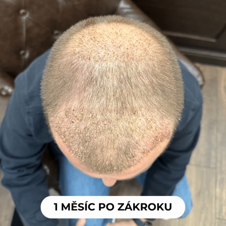1 měsíc po zákroku - fáze hojení