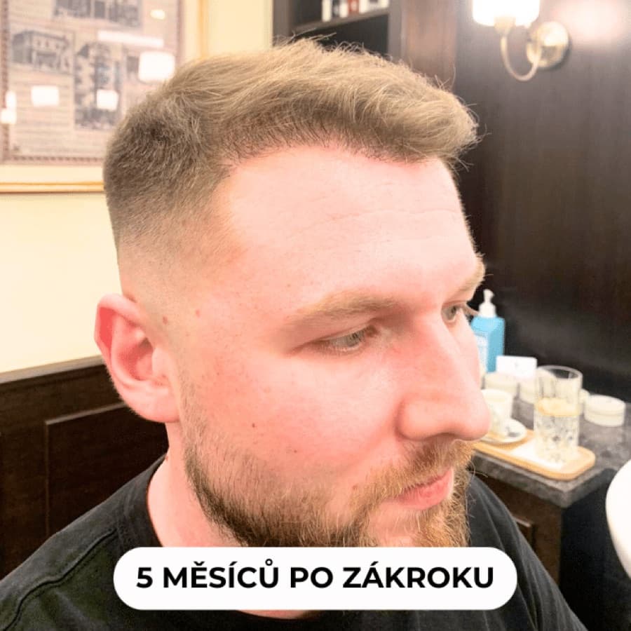 5 měsíců po zákroku - viditelné zahuštění