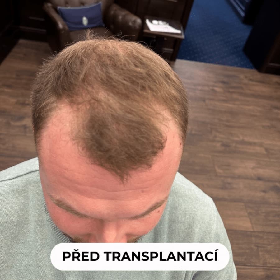 Před transplantací - prořídlé temeno a kouty